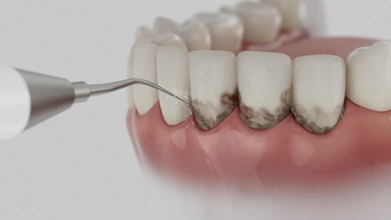 Reliable Tooth Extraction contractor in San Diego, CA by Smile Center Dentistry